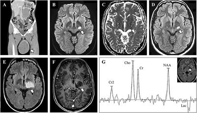 Case Report: Paraneoplastic Tumefactive Demyelination Associated With Seminoma